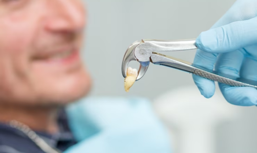Post-Tooth Extraction Care